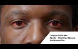 Viral conjunctivitis outbreak in northern Malawi